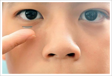 客製化角膜塑型片 驗配試戴不能省